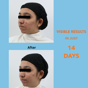 FAST CLEAR BPO FOAMING FACEWASH