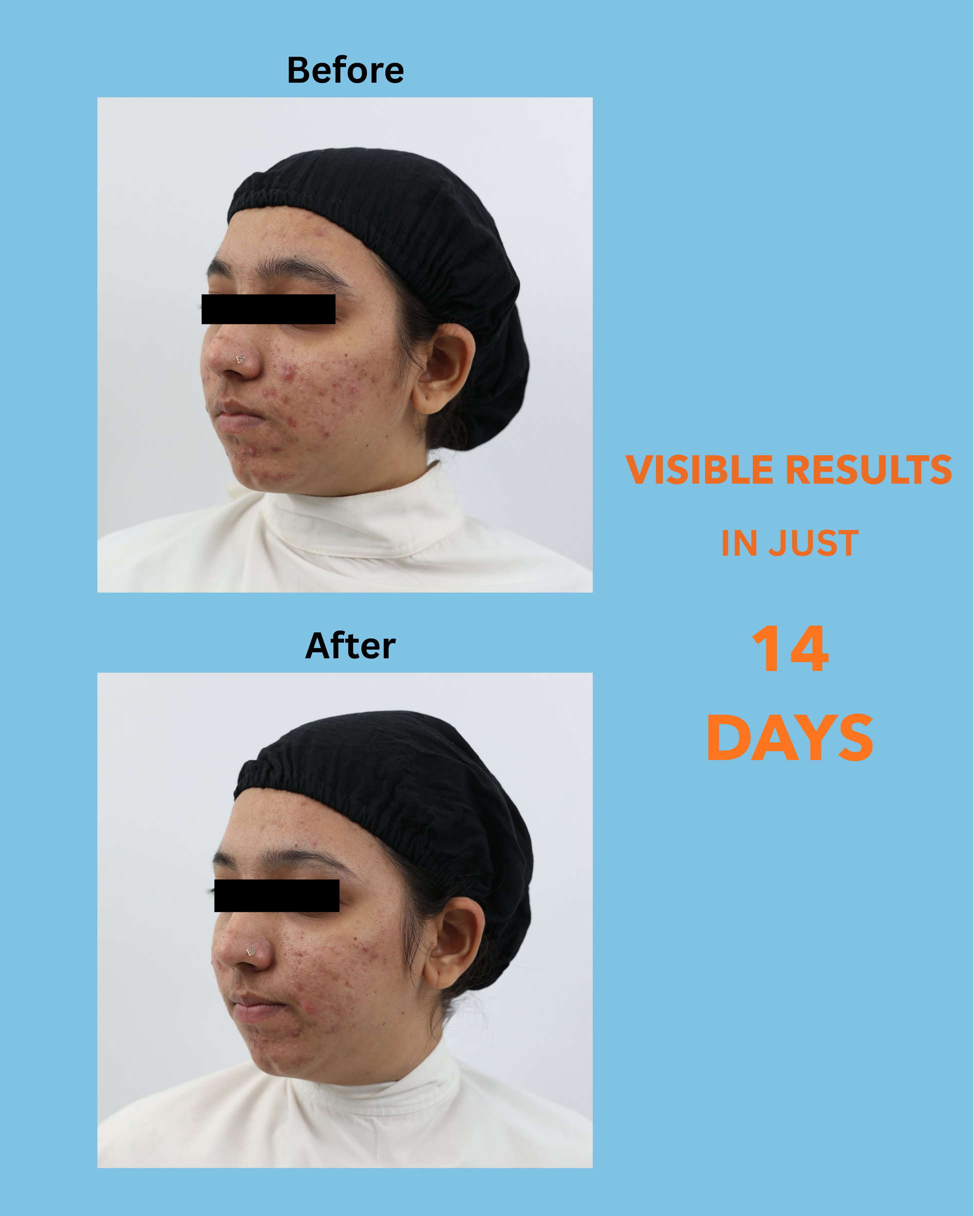 FAST CLEAR BPO FOAMING FACEWASH