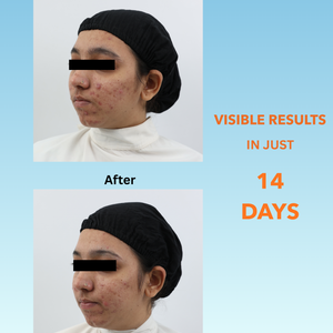 BLACKBELT DEFENCE KIT FOR ACNE AND PIMPLES