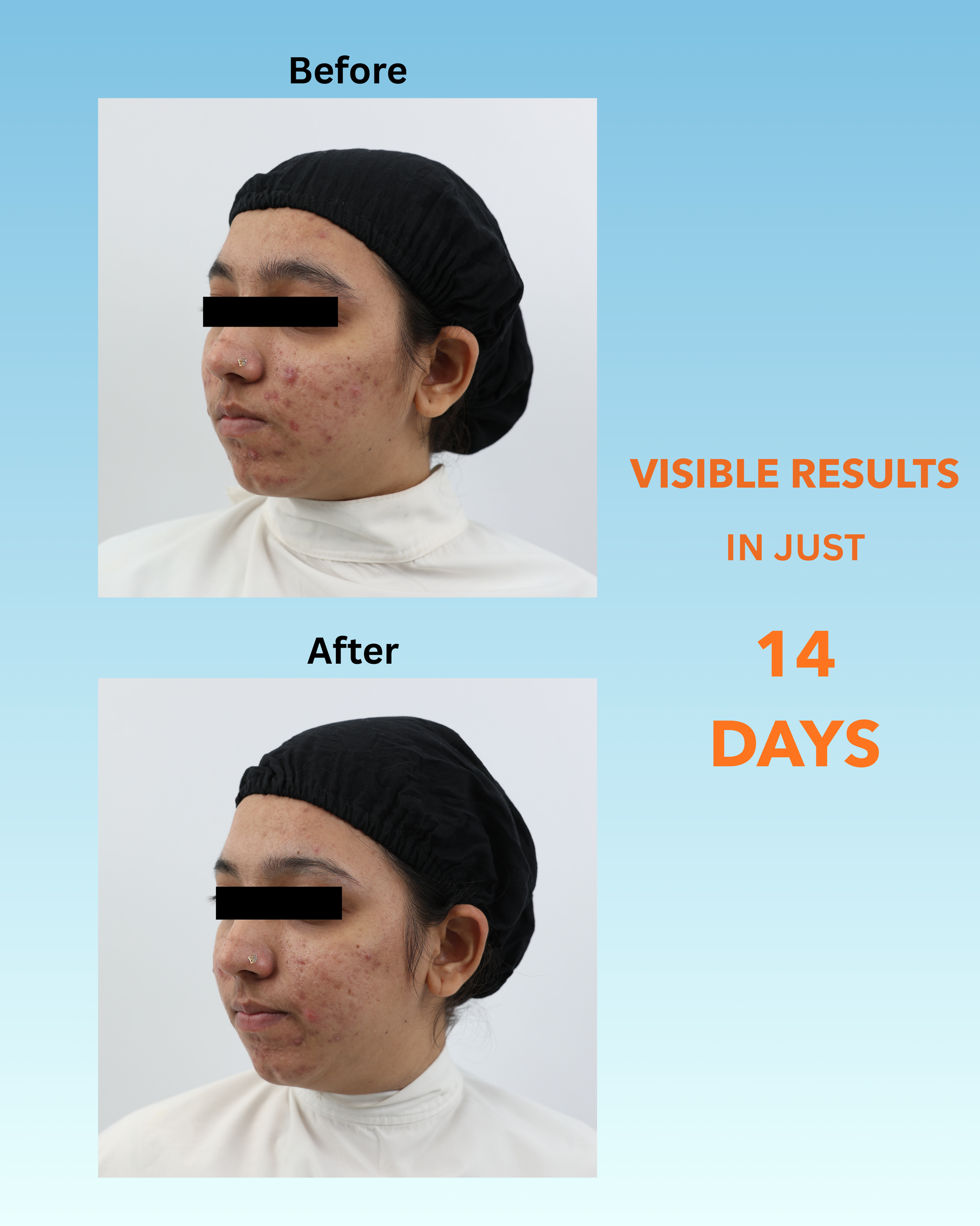 BLACKBELT DEFENCE KIT FOR ACNE AND PIMPLES