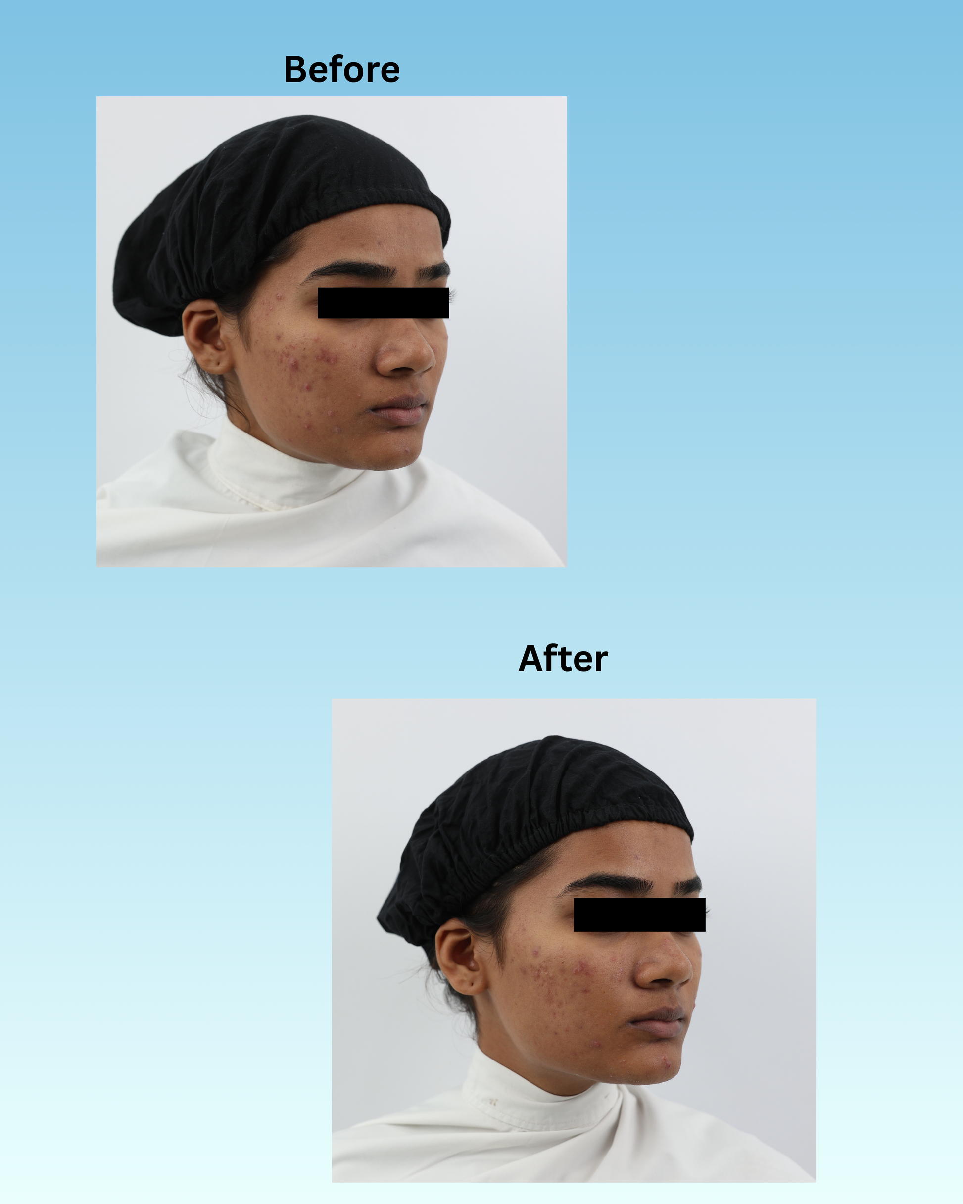 BLACKBELT DEFENCE KIT FOR ACNE AND PIMPLES